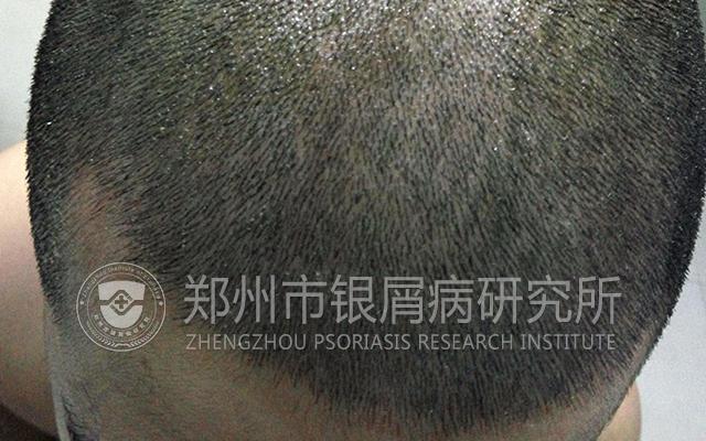 银屑病绝不能忌口,银屑病真的不能用激素么