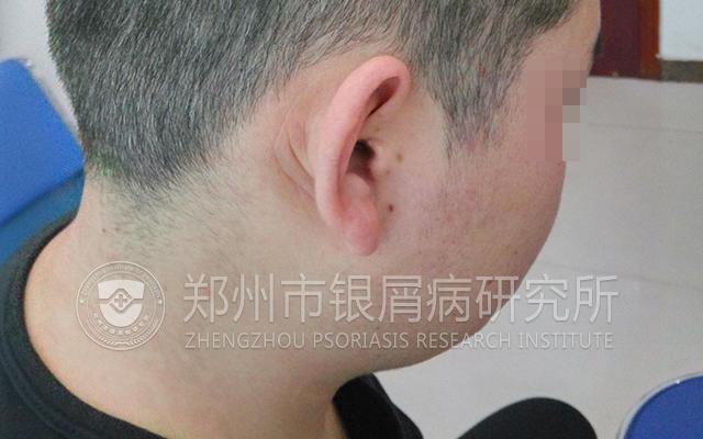 银屑病绝不能忌口,银屑病真的不能用激素么