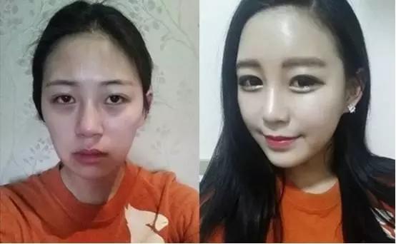 自体脂肪填充过来人的感受,自体脂肪全脸填充移位至颧骨