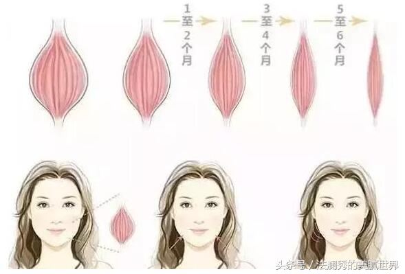 什么情况下会影响打瘦脸针的效果,打了瘦脸针要注意什么事项