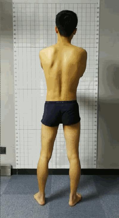 线下矫正案例分析|体态与步态的关系,粗细腿大小臀是怎么出现的