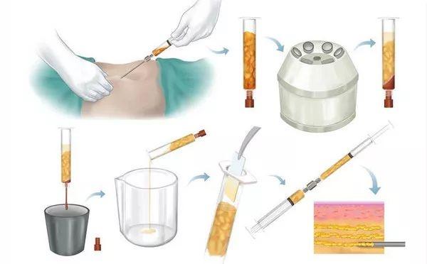 自体脂肪填充过来人的感受,自体脂肪全脸填充移位至颧骨