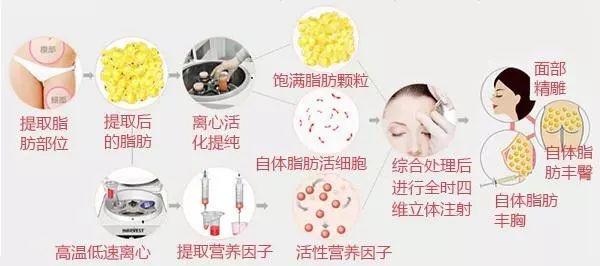 自体脂肪填充过来人的感受,自体脂肪全脸填充移位至颧骨