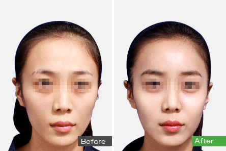 自体脂肪填充过来人的感受,自体脂肪全脸填充移位至颧骨