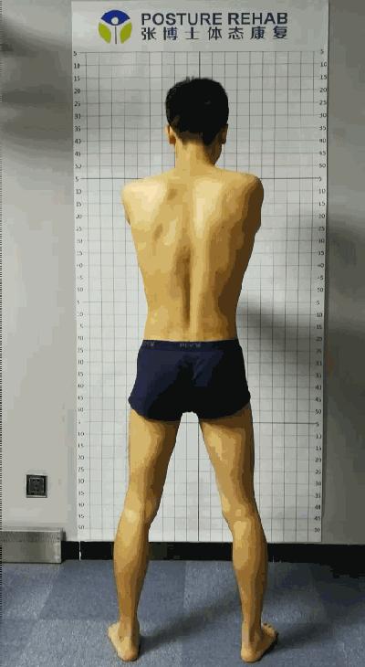 线下矫正案例分析|体态与步态的关系,粗细腿大小臀是怎么出现的
