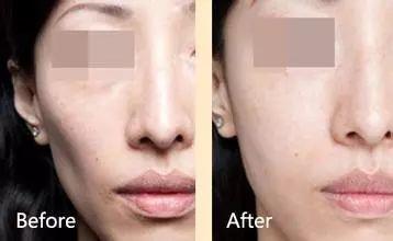 自体脂肪填充过来人的感受,自体脂肪全脸填充移位至颧骨