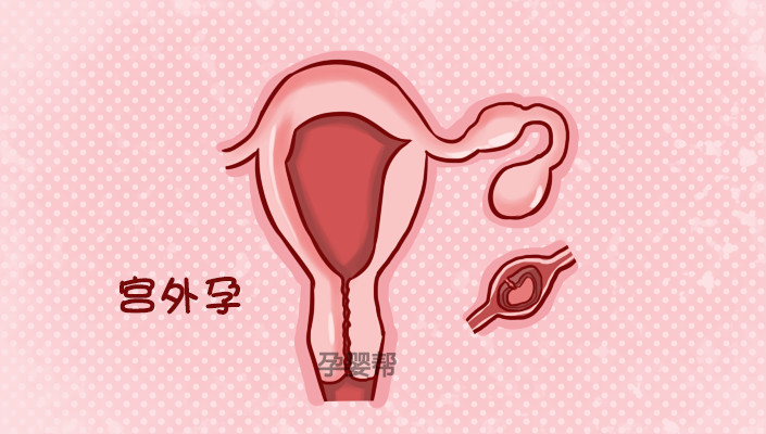 孕期宫腔出血肚子疼,怀孕有出血和腹痛一定是宫外孕吗