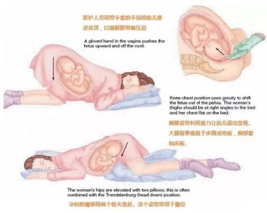 脐带脱垂的真实案例,怎么判断脐带脱垂