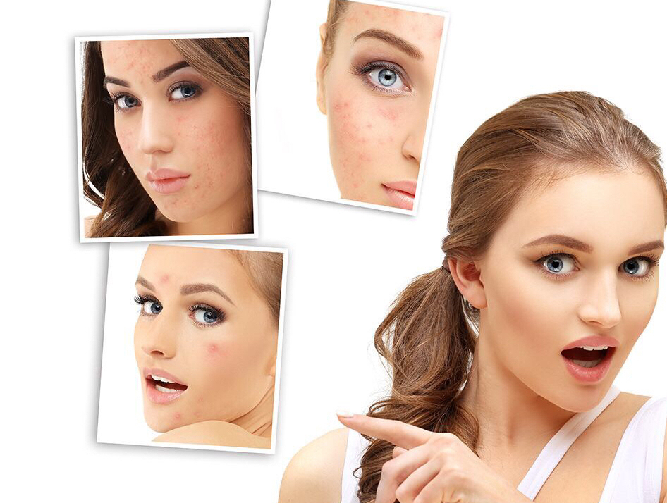 祛痘小妙招药片,医生药物祛痘印的小窍门