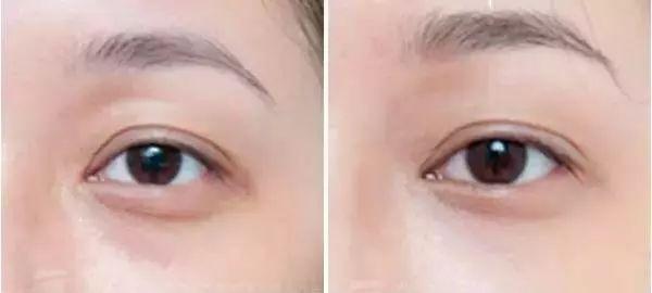 自体脂肪填充过来人的感受,自体脂肪全脸填充移位至颧骨