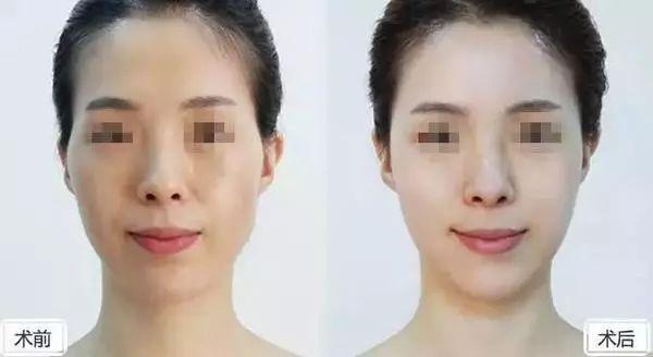 自体脂肪填充过来人的感受,自体脂肪全脸填充移位至颧骨