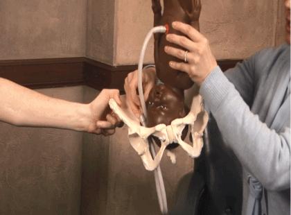 脐带脱垂的真实案例,怎么判断脐带脱垂