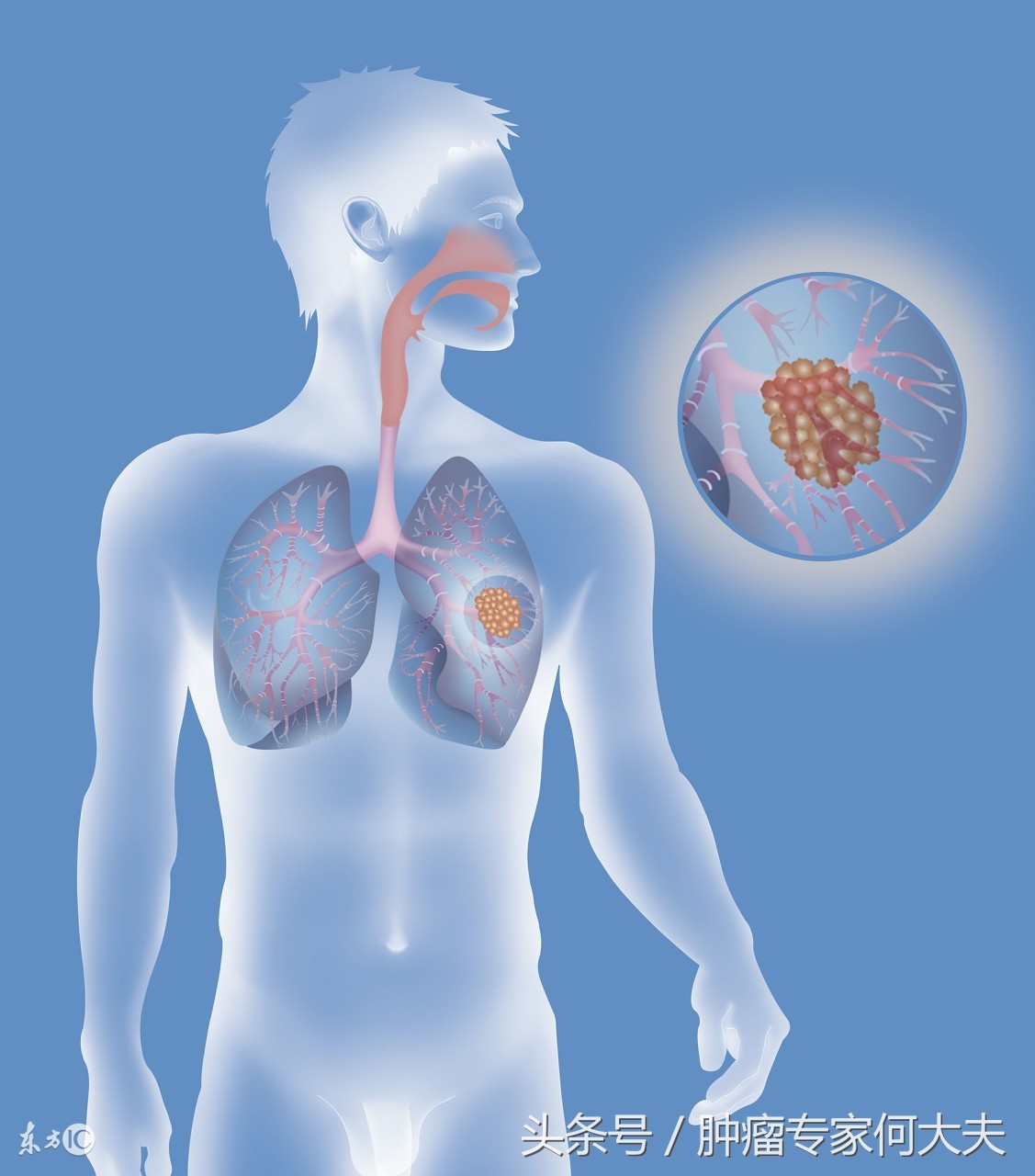 确诊是淋巴瘤要怎么办,淋巴瘤是怎样的血液病