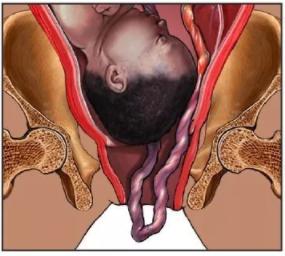 脐带脱垂的真实案例,怎么判断脐带脱垂