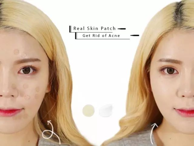 如何防治姨妈前长痘,怎么治疗姨妈痘