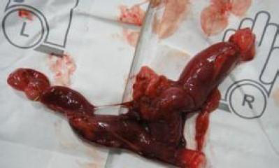 22岁孕妇生产后3天死亡,27岁孕妇顺产生孩子