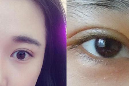 韩式埋线双眼皮能保持一辈子吗,韩式双眼皮可以提肌矫正吗