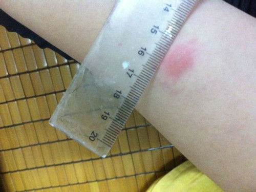 头孢皮试阳性医生说,青霉素过敏医生还继续给患者用药