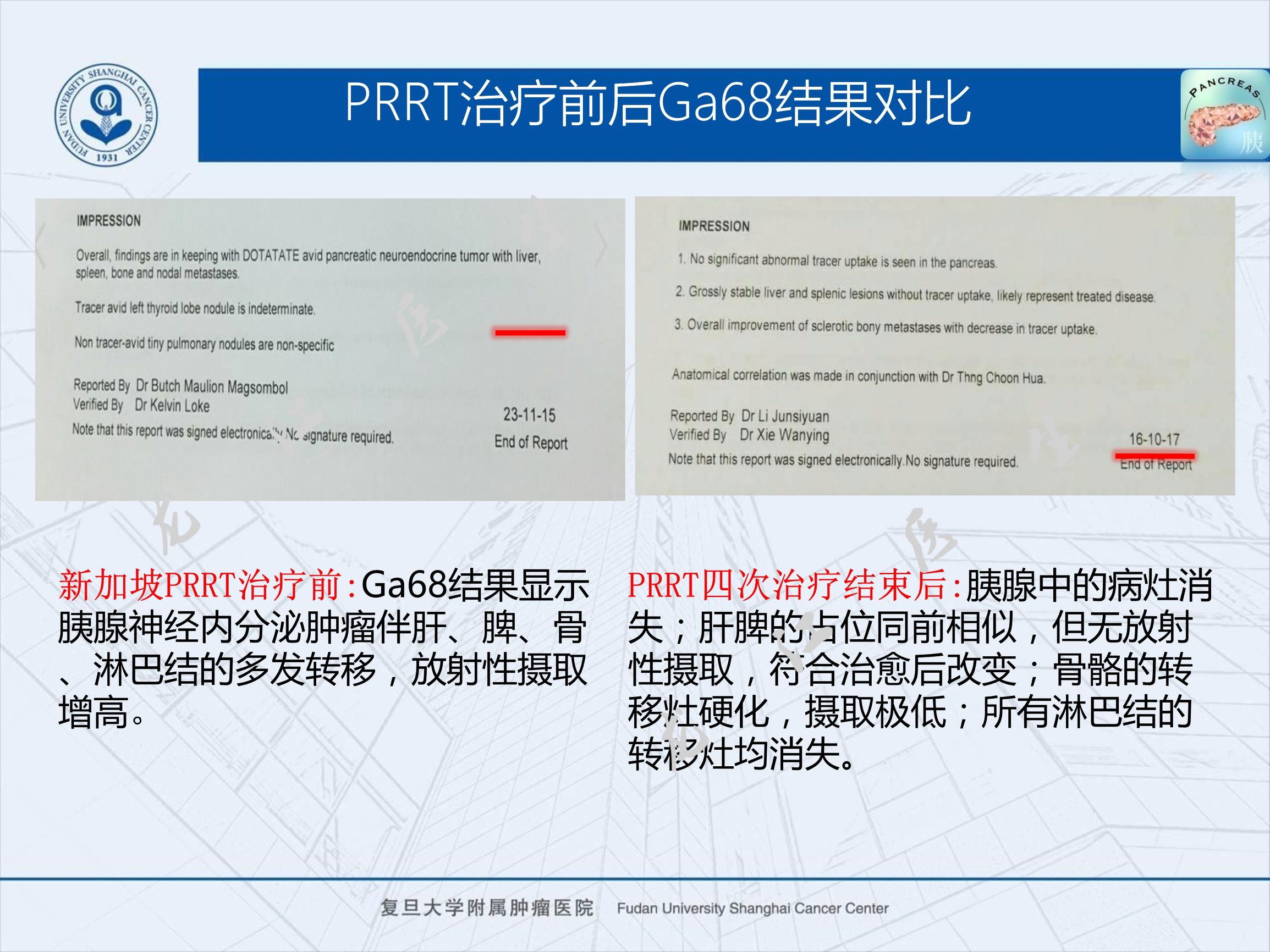 prrt治疗神经内分泌副作用,神经内分泌瘤ssrt