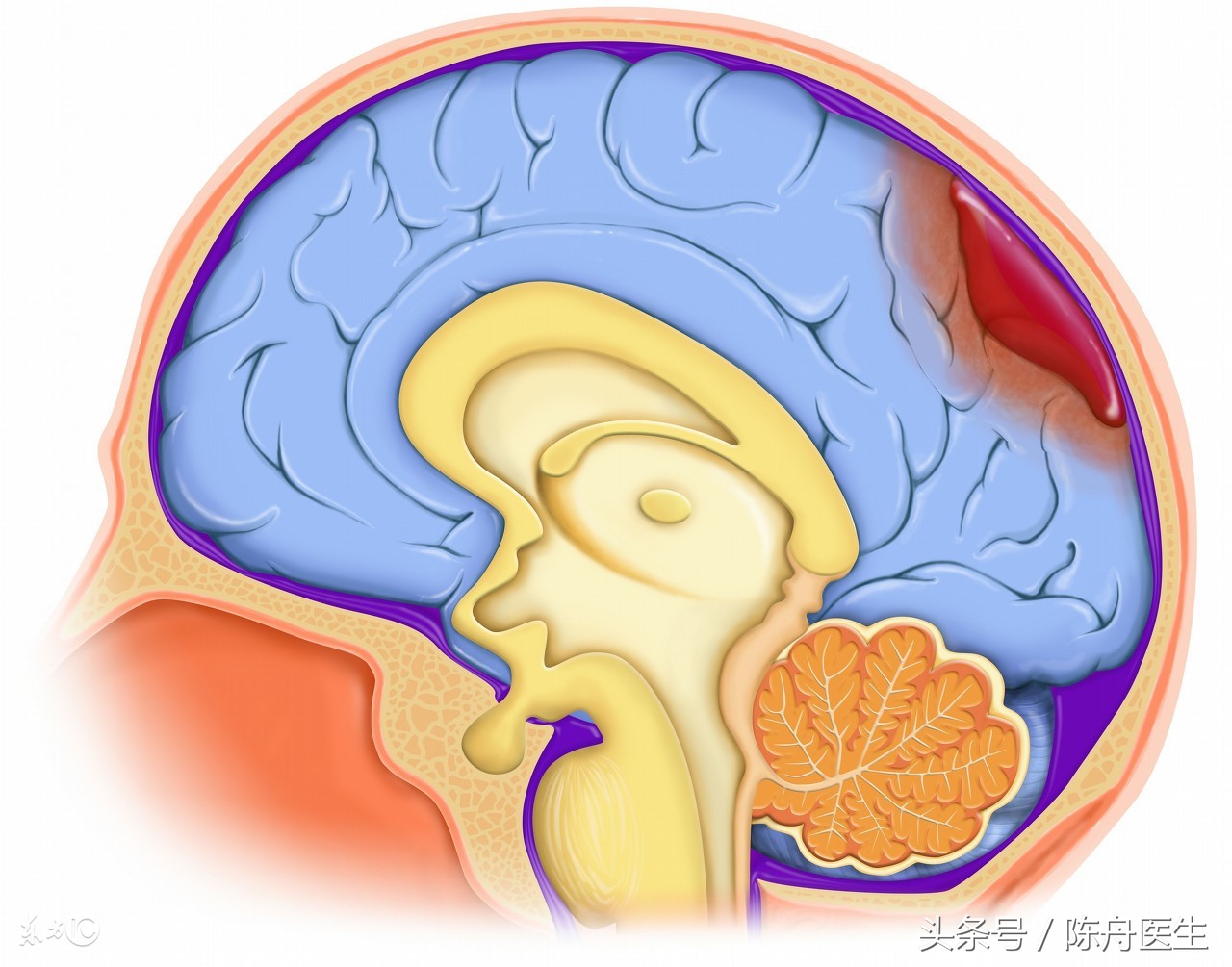脑出血后遗症肢体无力吃什么药,脑出血后遗症康复锻炼视频