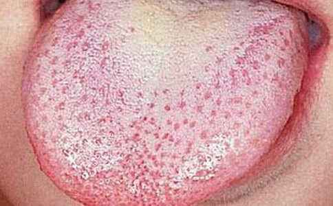 猩红热患儿的护理,猩红热宝宝注意事项