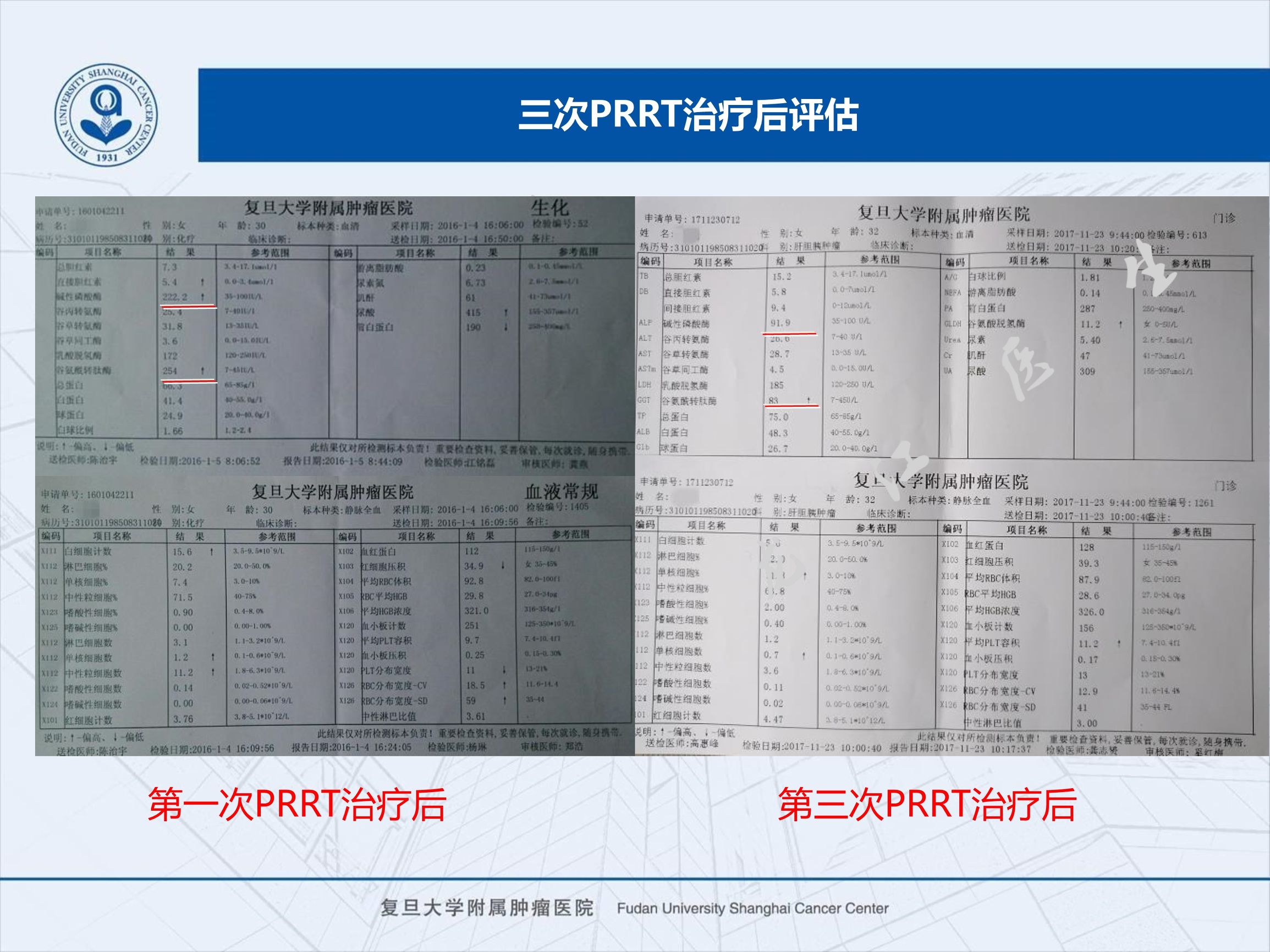prrt治疗神经内分泌副作用,神经内分泌瘤ssrt