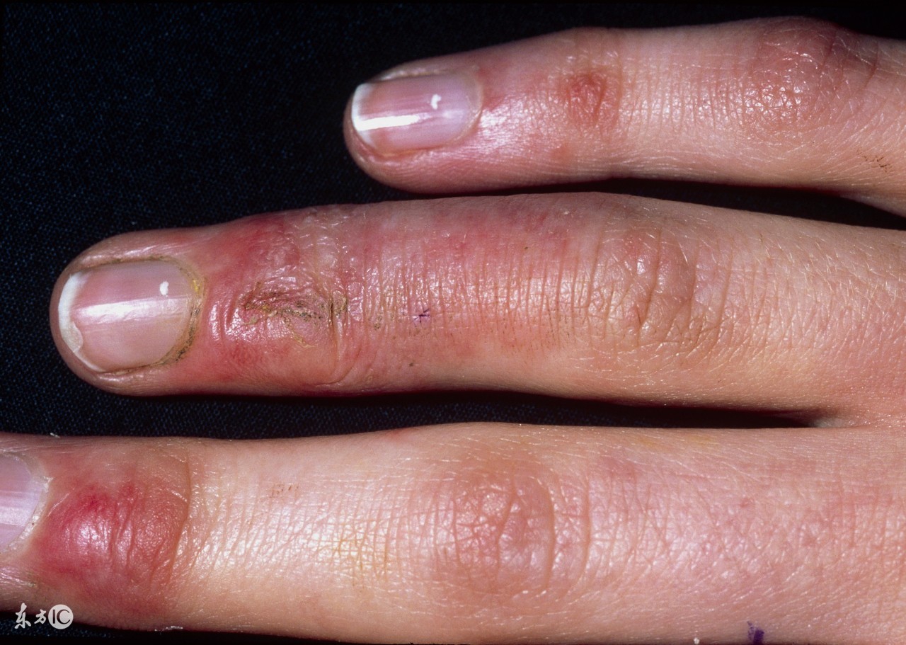 15个去除冻疮小绝招,12种方法赶走冻疮