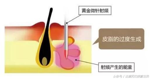 月球表面怎么祛痘,月球表面痘印怎么修复