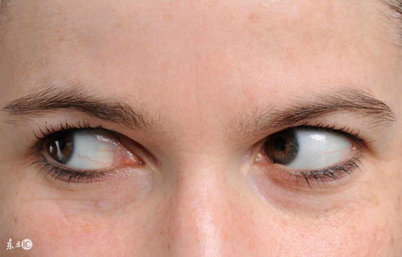 两眼近视度数有差距，该怎么办？