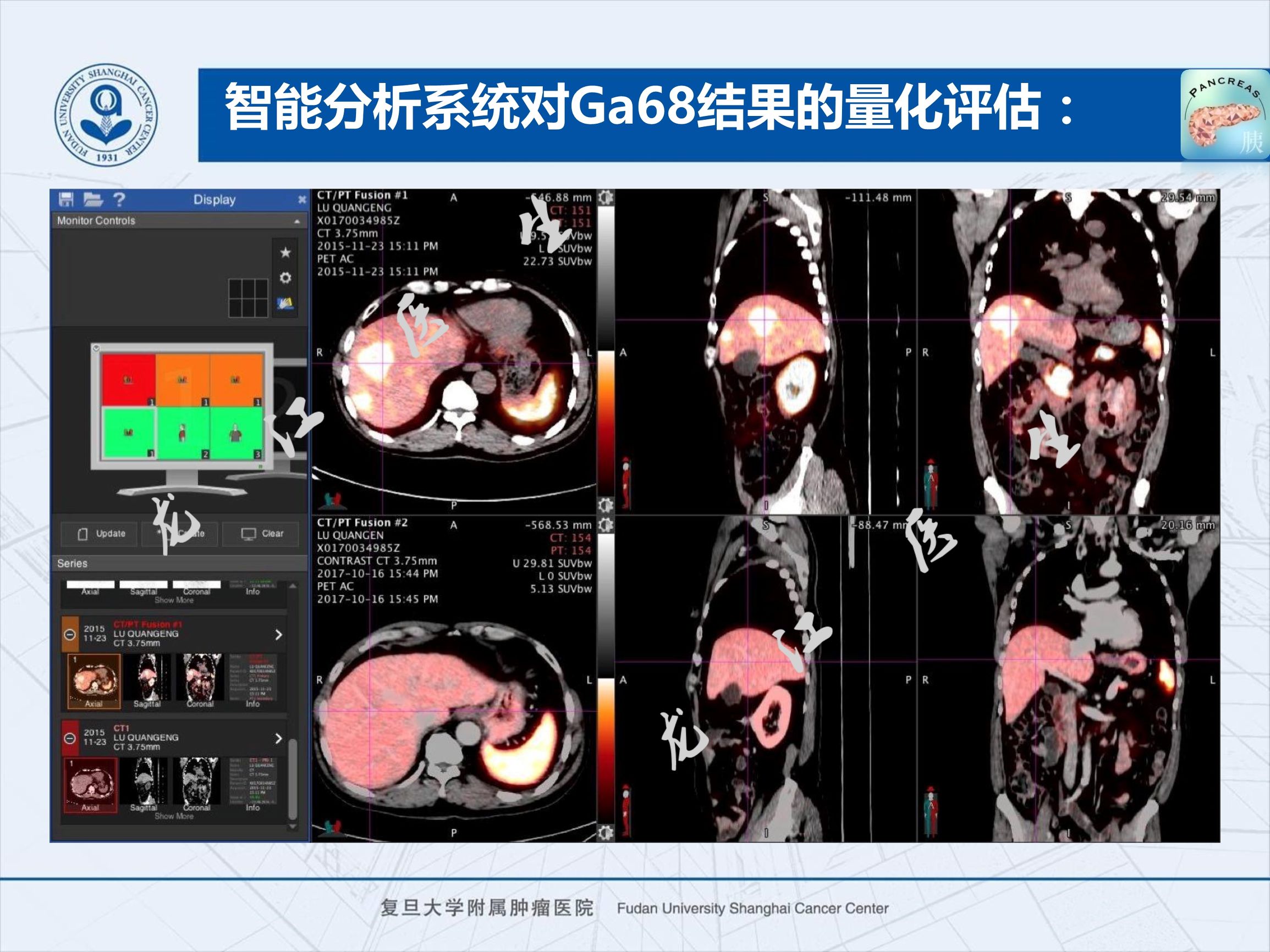 prrt治疗神经内分泌副作用,神经内分泌瘤ssrt