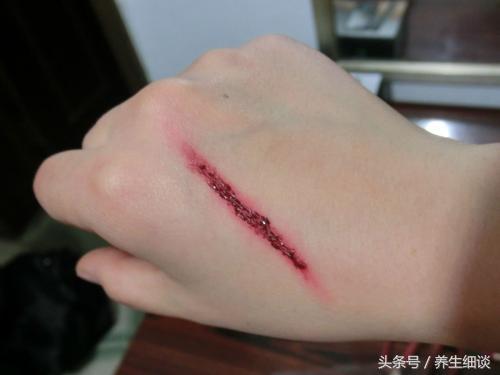 4个原因是糖尿病人伤口难愈合的罪魁祸首；6个方法，促进伤口恢复