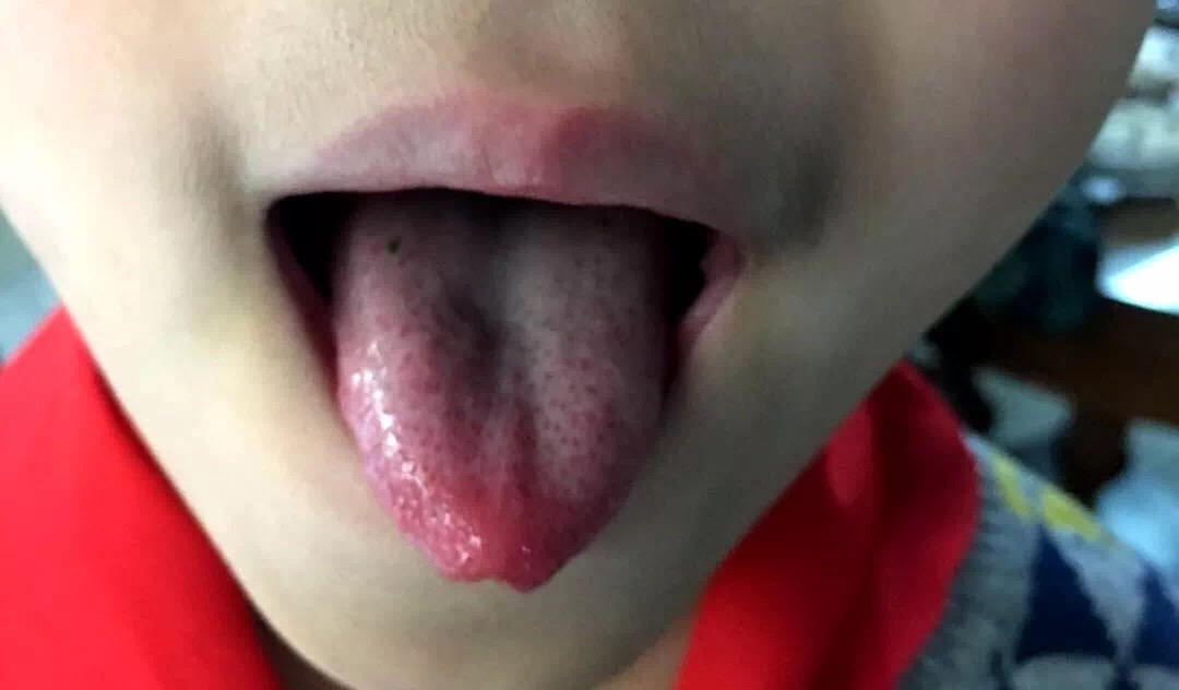 根据舌苔辨别身体情况,舌苔白厚什么原因吃什么中成药