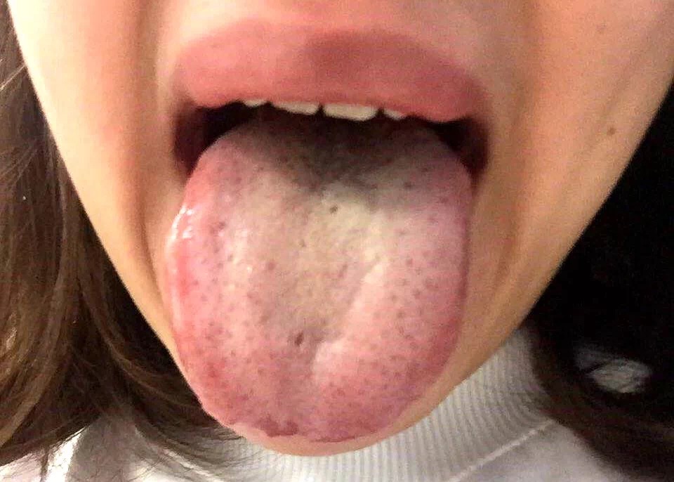 根据舌苔辨别身体情况,舌苔白厚什么原因吃什么中成药