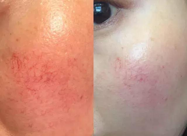 敏感肌卸妆洁面乳,适合敏感肌用的去角质洁面乳