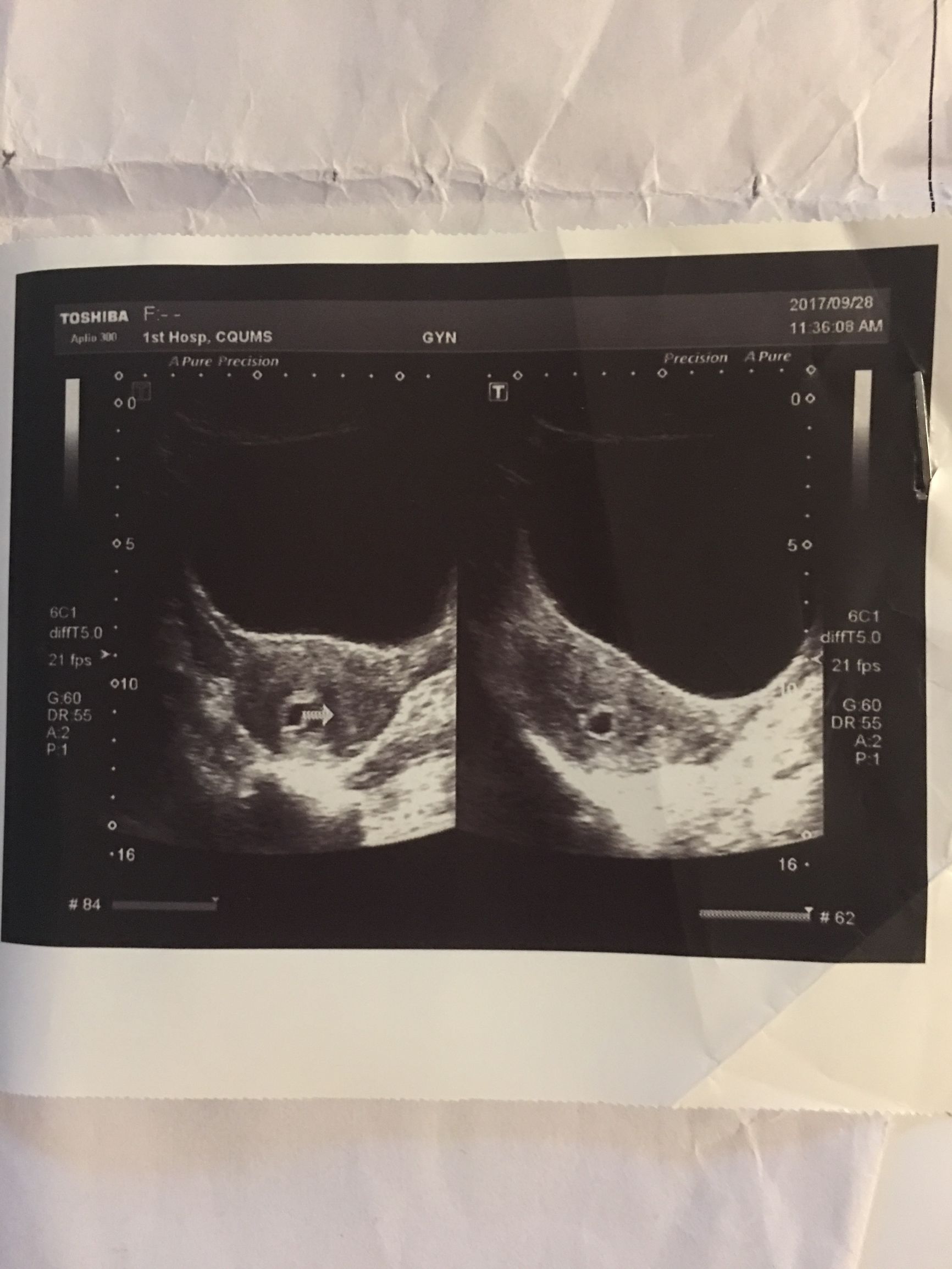 怀孕不易,保胎亦不易,顺利流产更是不易……