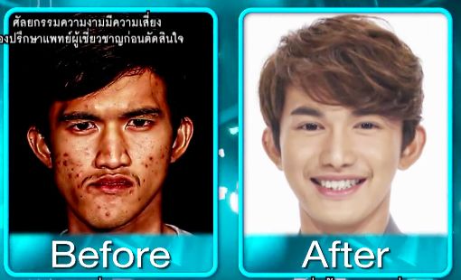 泰国整形节目叫什么,泰国整形填充额头