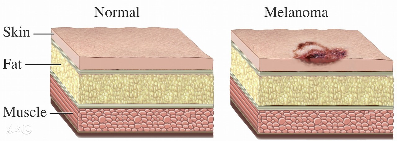线状表皮痣会引发皮肤癌吗,痣引发的皮肤癌几率大
