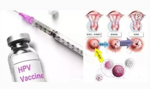 陕西2022年四价宫颈癌疫苗预约,四价宫颈癌疫苗有没有必要打