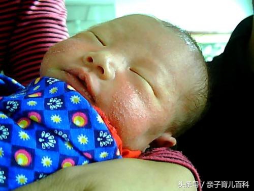 十岁湿疹反反复复不好,儿童嘴角湿疹反反复复