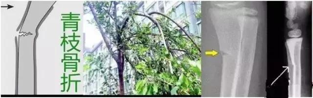 青枝骨折愈合大致分为三期,儿童青枝骨折的特点以及处理要点