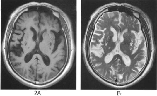 血管周围间隙的核磁影像学表现,颅脑血管间隙mri图像