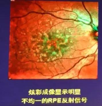 COFDS2016KarlG.Csaky：视网膜色素上皮脱离在干性AMD进展中的影响