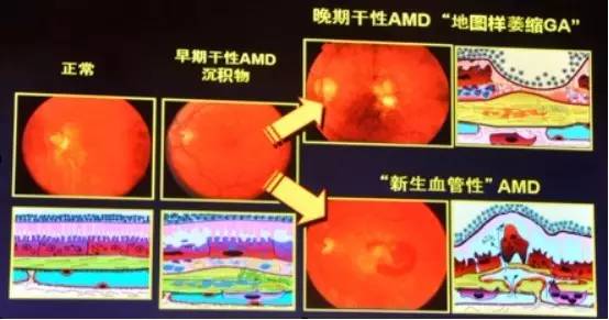 COFDS2016KarlG.Csaky：视网膜色素上皮脱离在干性AMD进展中的影响