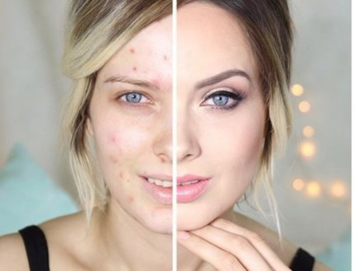 女子花了1万3祛痘,女子花费万元祛斑