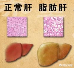 运动后转氨酶升高,喝中药转氨酶升高