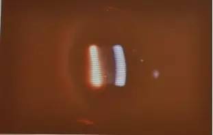 葡萄膜炎专家共识,急性前葡萄膜炎鉴别诊断