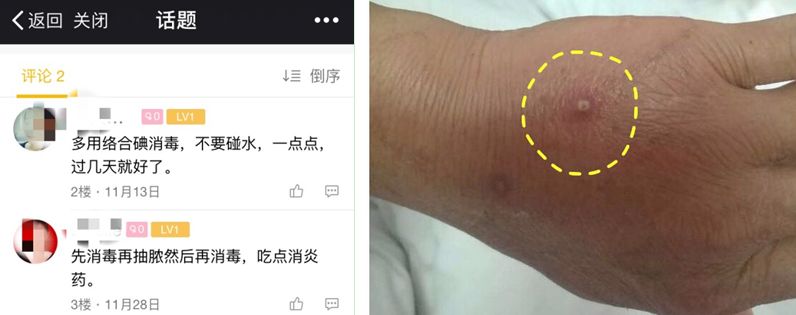 穿刺点感染怎么办?两种方法任你选