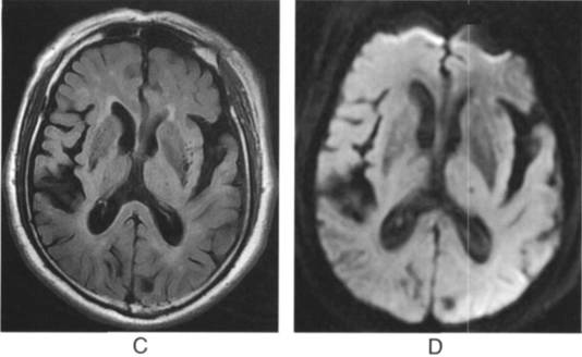血管周围间隙的核磁影像学表现,颅脑血管间隙mri图像