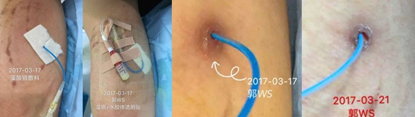 穿刺点感染怎么办?两种方法任你选