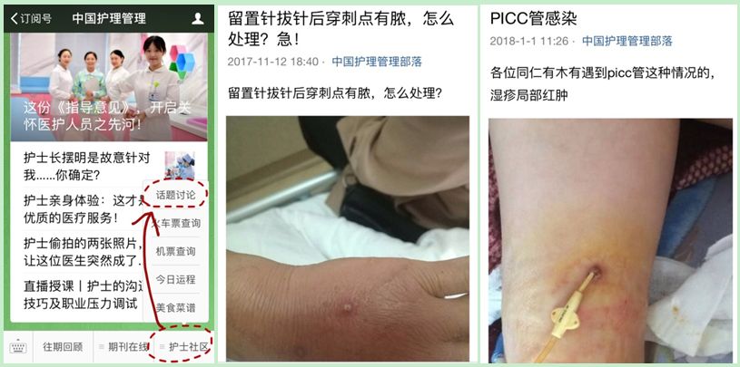 穿刺点感染怎么办?两种方法任你选